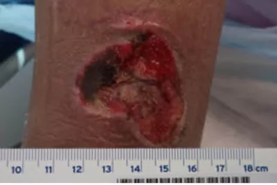 Surgical Wound Case Study - First picture of wound