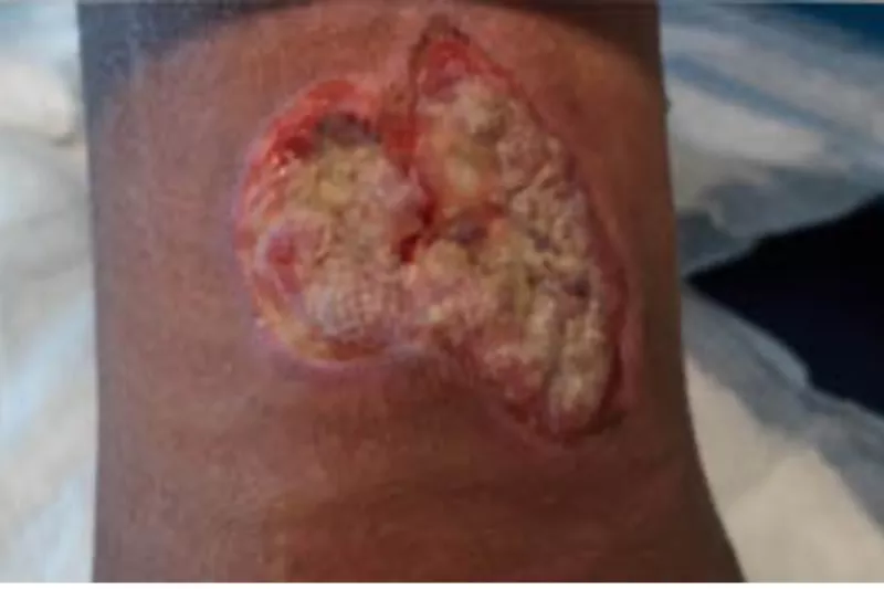 Surgical Wound Case Study - Week 1 of Treatment