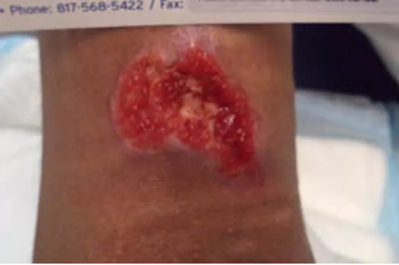 Surgical Wound Case Study - Week 2 of Treatment