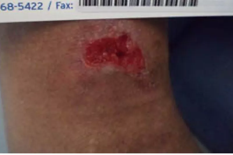 Surgical Wound Case Study - Week 4 of Treatment